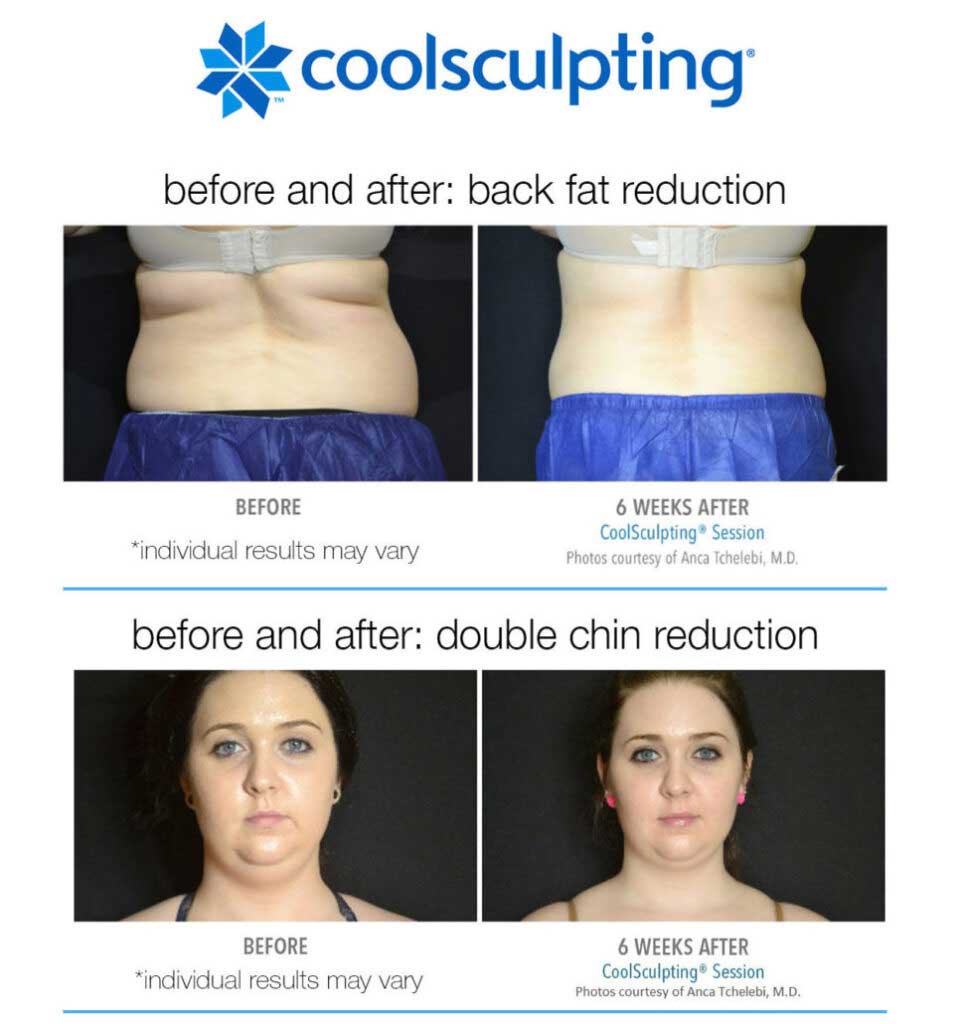 CoolSculpting Before and After, Real Patient Results