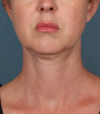 before photo of jawline treatment
