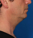 before photo of jawline treatment