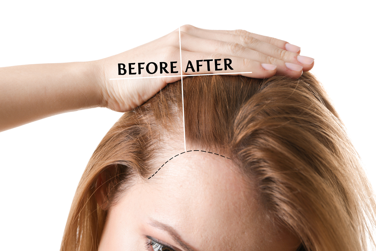 Featured image for “Your Guide to NeoGraft® FUE – Why You Might Need It”